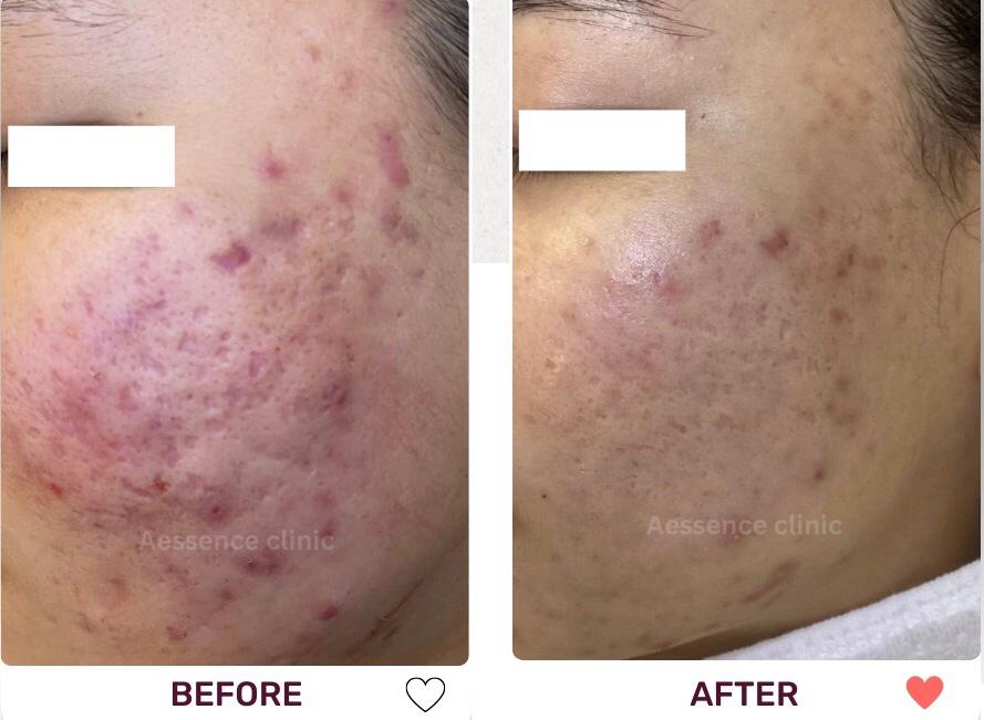 Before and After Acne Treatment
