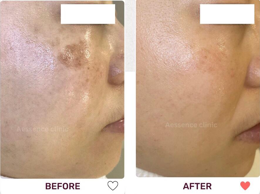 Before and After Acne Treatment