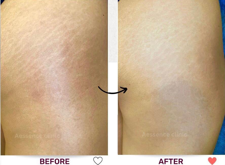 Before and After Acne Treatment