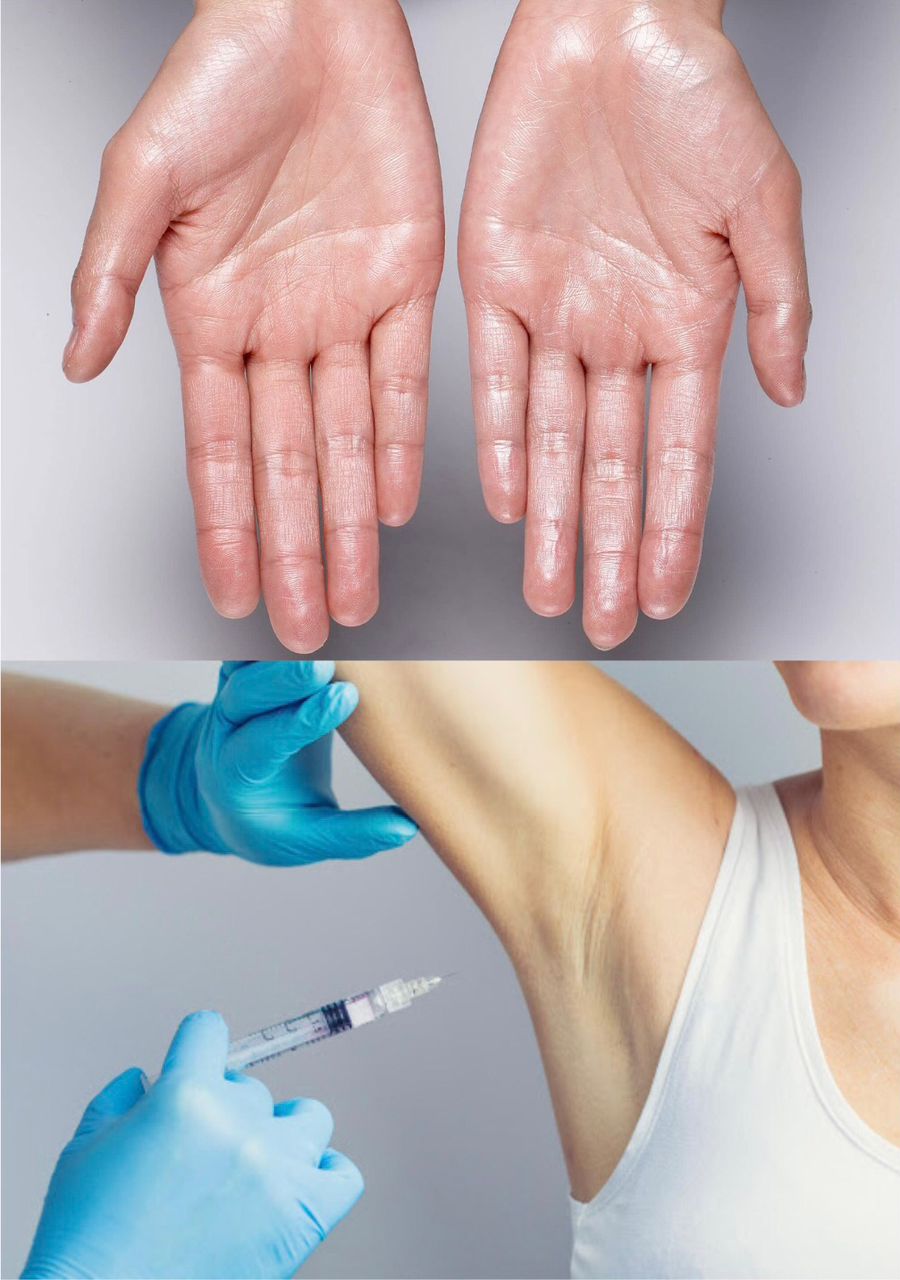 Excessive sweating