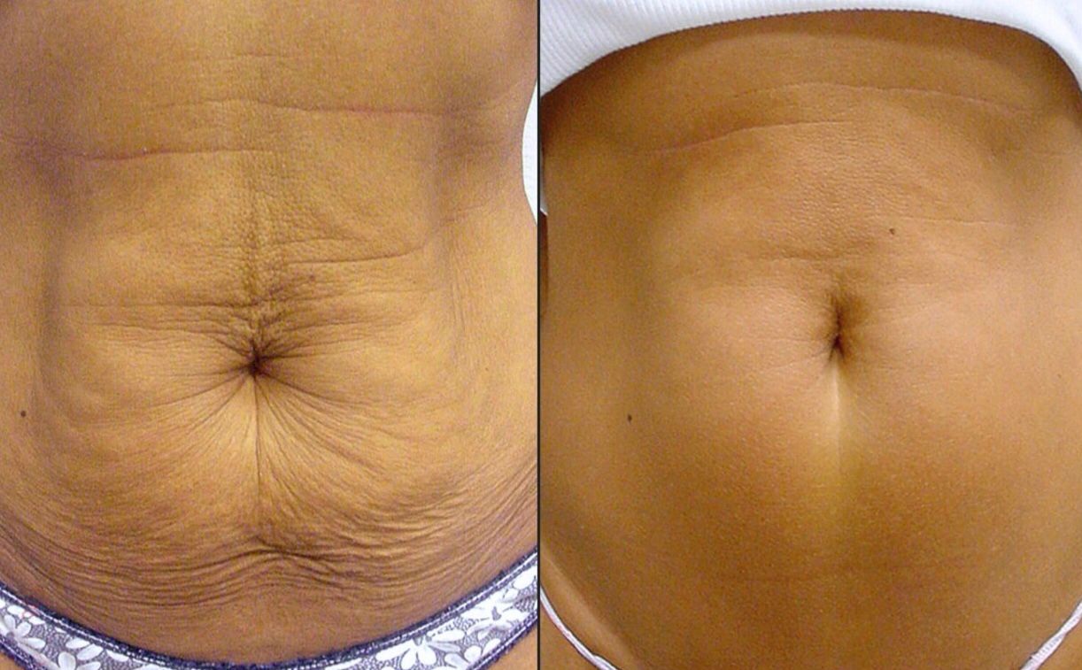 Weight management