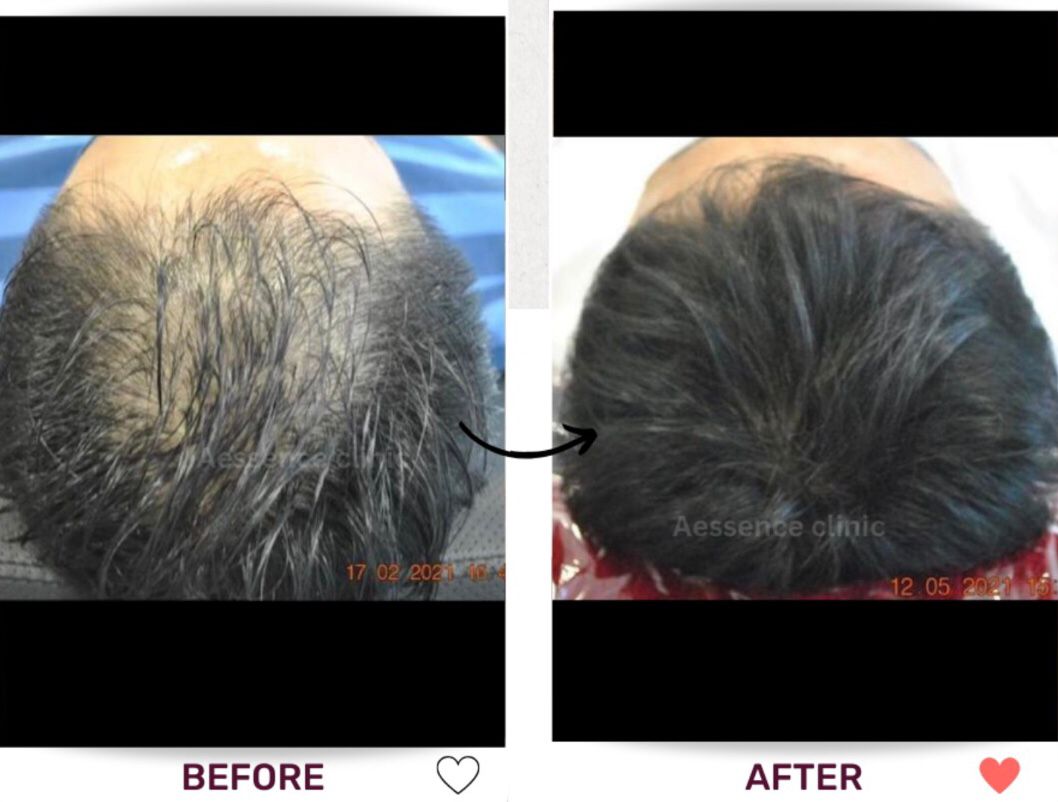 Hair thinning / hair loss