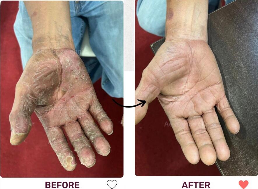 Before and After Acne Treatment
