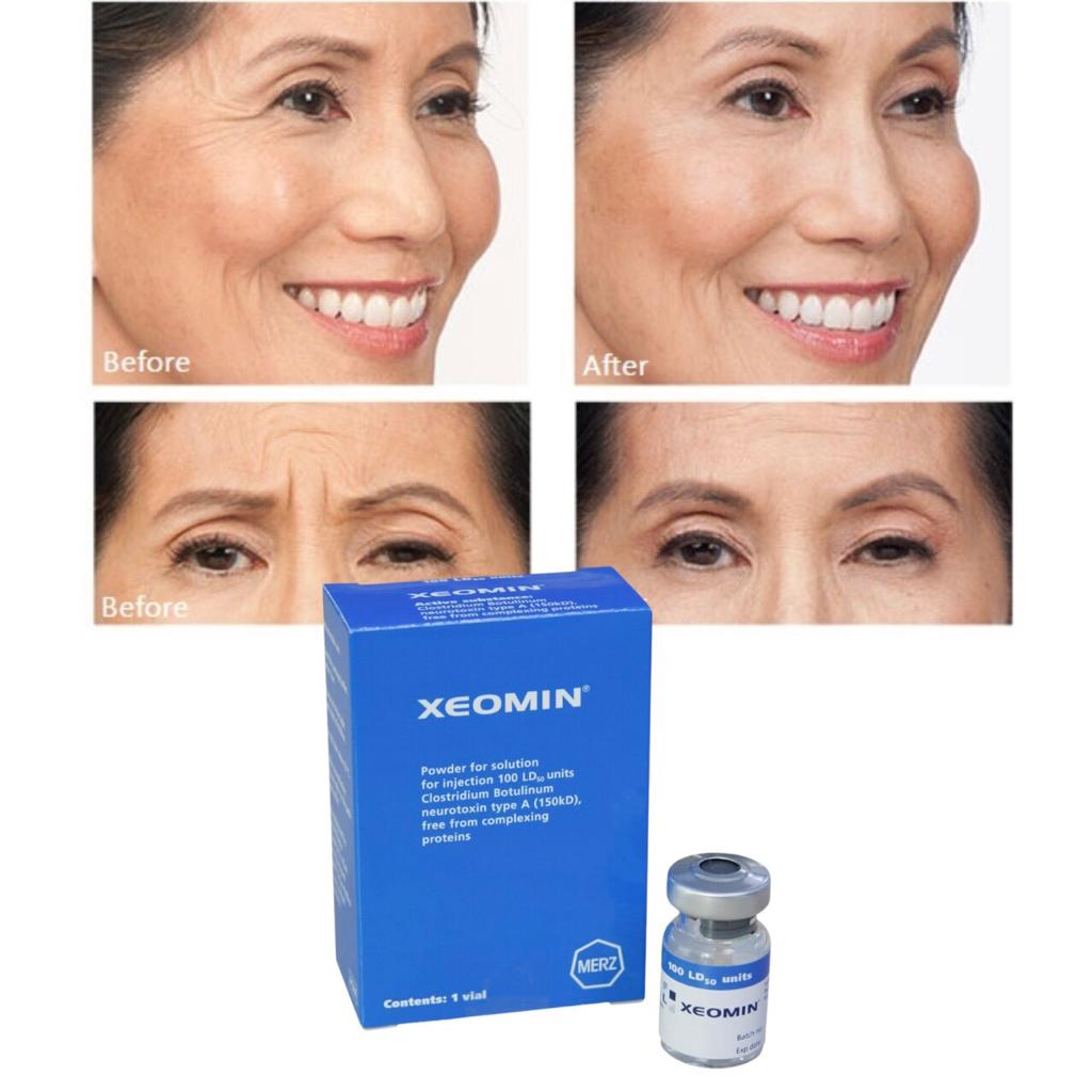 Botulinum Toxin A injection