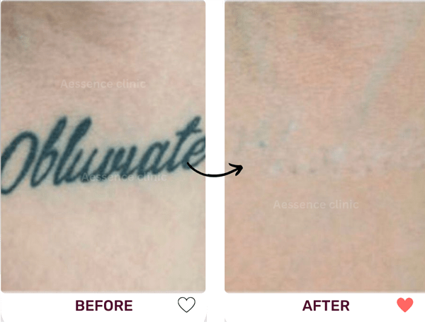 Tattoo removal